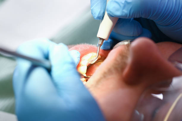 Best Emergency Dentist for Lost Fillings or Crowns in Boiling Springs, PA